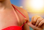 Fot. do artykułu: 'Jak leczyć oparzenia słoneczne?'