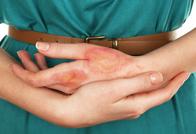 Pierwsza pomoc na oparzenia - domowe sposoby