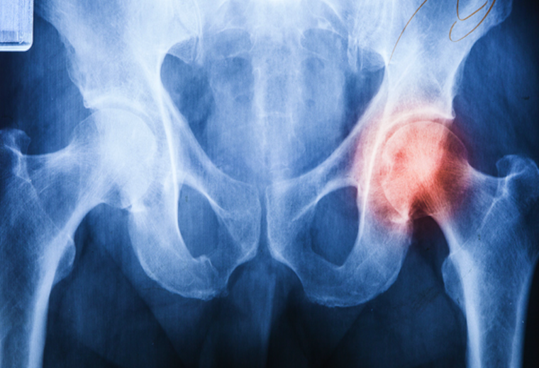 Choroba zwyrodnieniowa stawów – sposoby na uniknięcie wózka inwalidzkiego