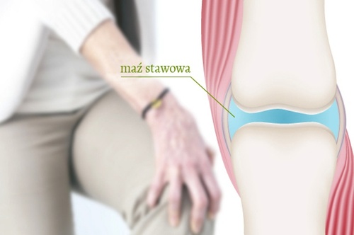 Zwyrodnienie stawów: spróbuj glukozaminy …