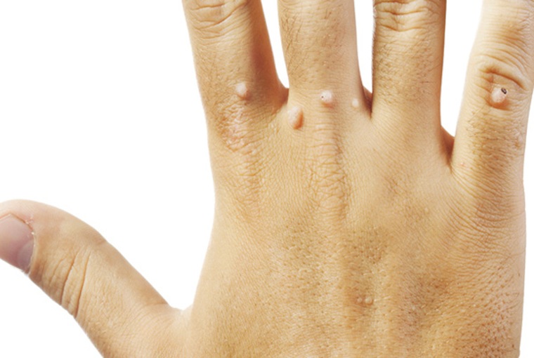 Fot. do artykułu: 'Brodawki (kurzajki) – niezliczone …'