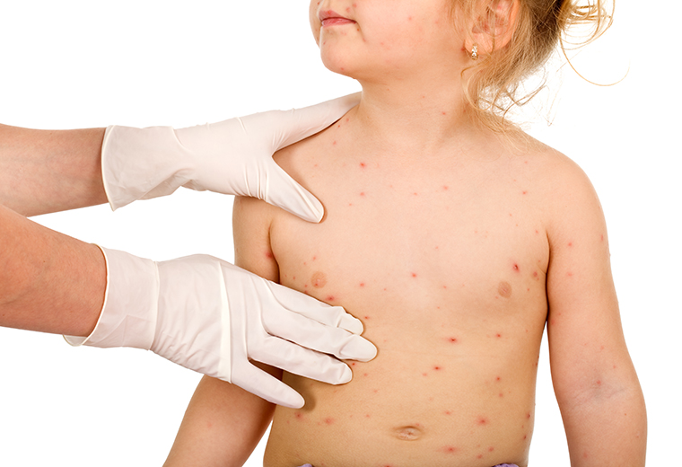 Fot. do artykułu: 'Ospa wietrzna u dzieci'