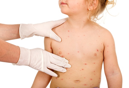 Ospa wietrzna u dzieci