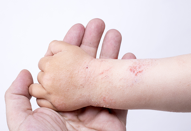 Pielęgnacja suchej skóry u dzieci.