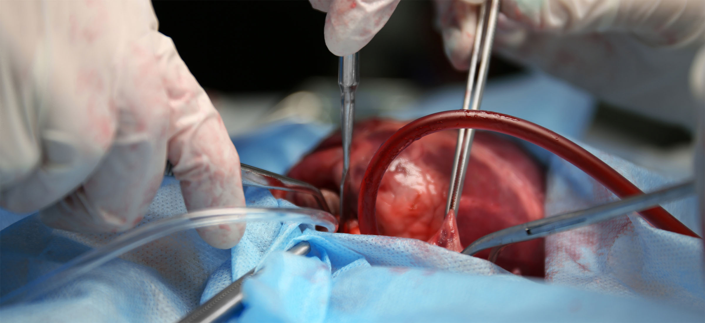 Przeszczep serca od świni. Kolejny postęp w ksenotransplantacji