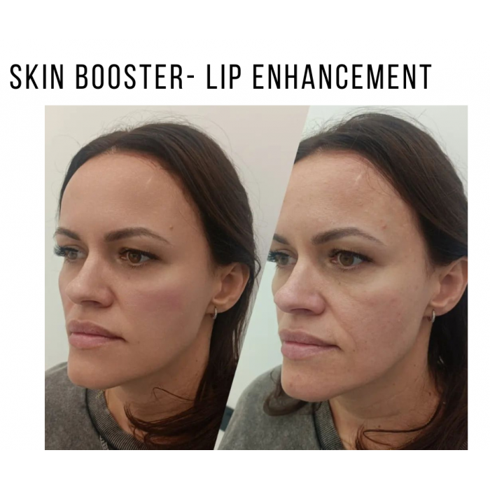 0758-425 9618 Zastrzyki przeciwzmarszczkowe