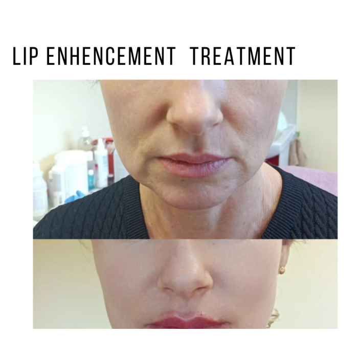 0758-425 9618 Zastrzyki przeciwzmarszczkowe