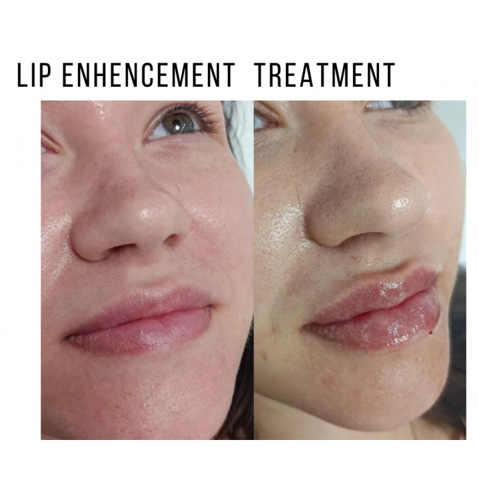 0758-425 9618 Zastrzyki przeciwzmarszczkowe