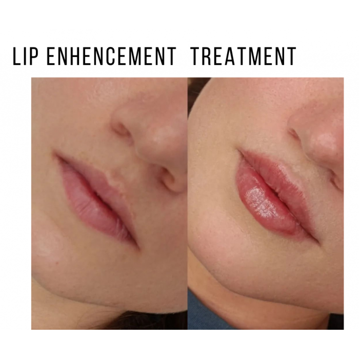 0758-425 9618 Zastrzyki przeciwzmarszczkowe